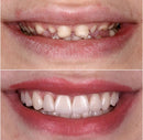 Kit com 2 Placas Dentais de Cerâmica Brancas – PARA TODAS ARCARIAS – Sorriso Perfeito